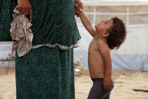 Catapora se espalha pelos superlotados acampamentos de deslocados em Gaza