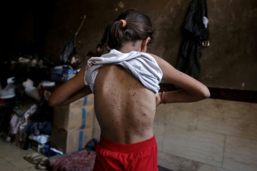 Uma menina palestina deslocada com catapora mostra as bolhas nas costas em Khan Yunis, no sul da Faixa de Gaza, em 19 de julho de 2026 — Bashar Taleb / AFP