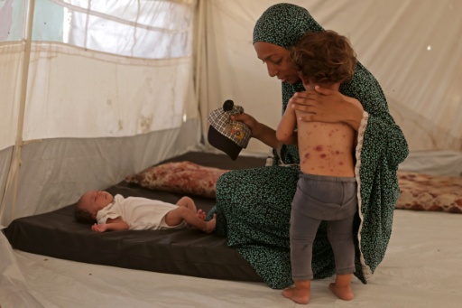 Rouba, enfant palestinienne, souffrant de varicelle, avec sa mère sous unbe tente à Khan Younes, dans la bande de Gaza, le 19 juillet 2026 — Bashar Taleb / AFP
